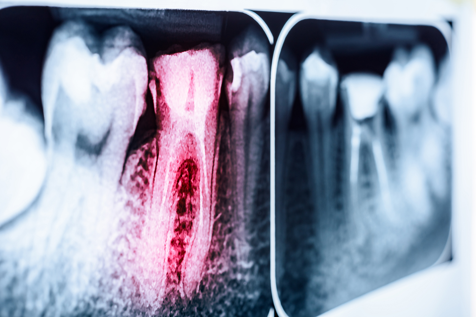 The image displays an X-ray film with multiple teeth visible against a black background, showing a range of dental conditions from healthy to potentially problematic, with one tooth highlighted by a red arrow, possibly indicating a specific issue for further examination or treatment.