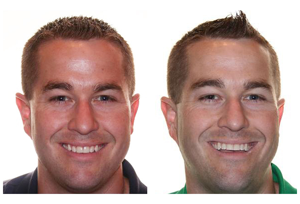 Straight Teeth 4 Less