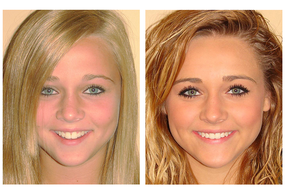 Straight Teeth 4 Less